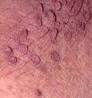 fibromi visece bradavice