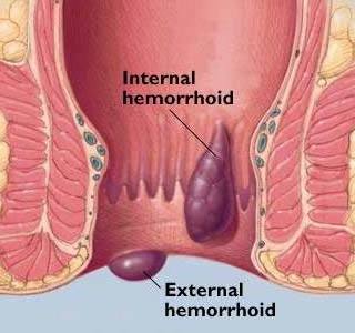 šta su hemoroidi