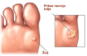 Žulj